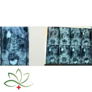 نمونه‌ای از انسداد محل اتصال لگنچه به حالب (UPJO)