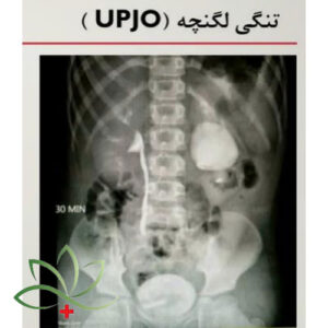 تنگی لگنچه(UPJO)