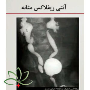 آنتی ریفلاکس مثانه